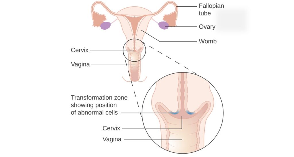 Female reproductive system, Squamocolumnar junction, Cervical transformational zone, Cervix, Health screening test