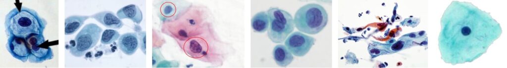 LSIL, HSIL, NILM, ASC-H, Squamous Cell Carcinoma, Atypical Squamous Cells with Unparalleled precision