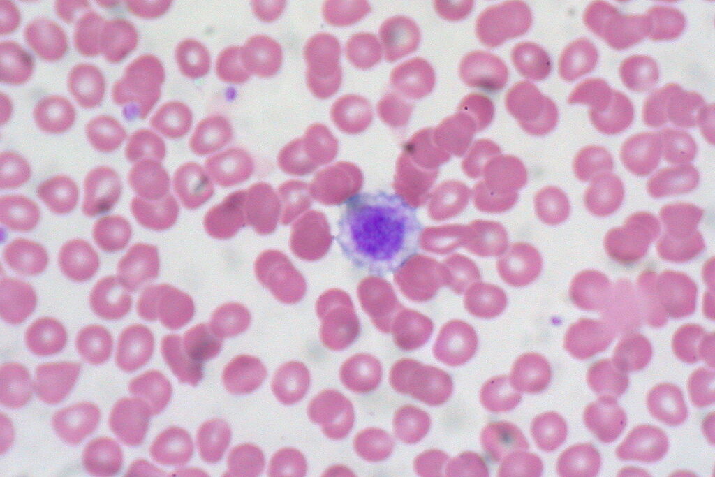 Thrombocytosis, Mean platelet volume, Platelet distribution width, Giant platelet, Agglutination