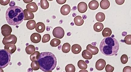 Thrombocytosis, Mean platelet volume, Platelet distribution width, Giant platelet, Agglutination