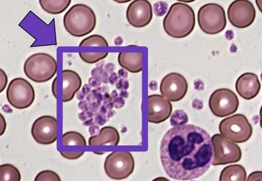 Thrombocytosis, Mean platelet volume, Platelet distribution width, Giant platelet, Agglutination