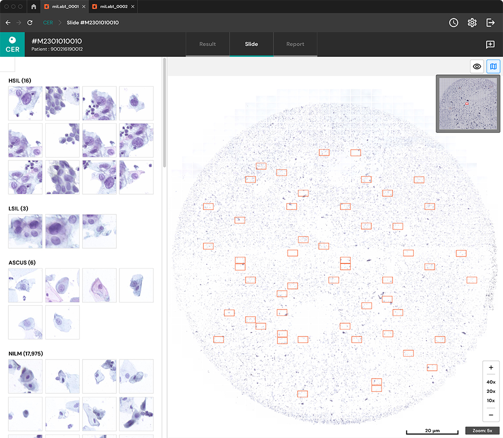 LSIL, HSIL, NILM, ASC-H, Squamous Cell Carcinoma, Atypical Squamous Cells with Unparalleled precision