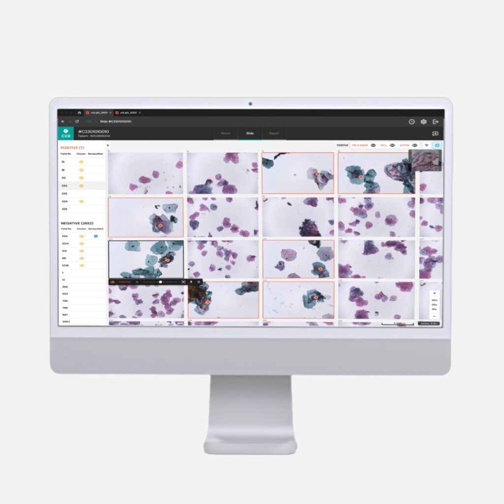 LSIL, HSIL, NILM, ASC-H, Squamous Cell Carcinoma, Atypical Squamous Cells with Unparalleled precision