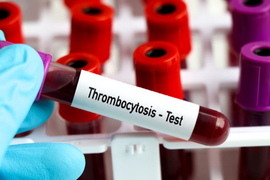 Thrombocytosis, Mean platelet volume, Platelet distribution width, Giant platelet, Agglutination