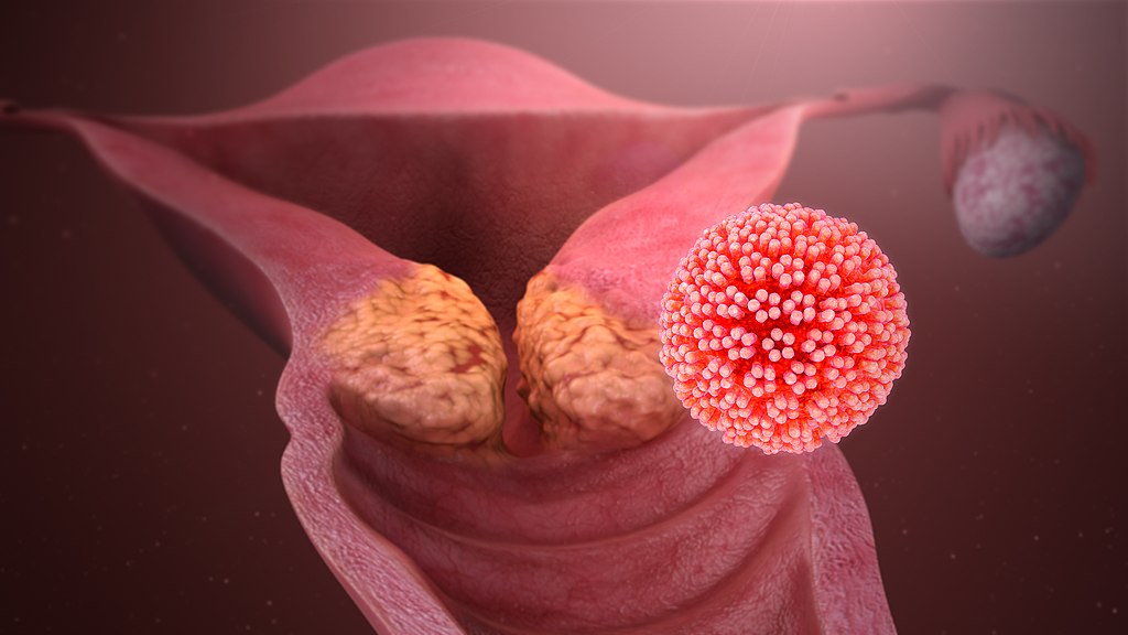 HPV 16, HPV high-risk types, Pap smear vs HPV test, HPV mRNA E6/E7 detected, HPV genotype 18/45