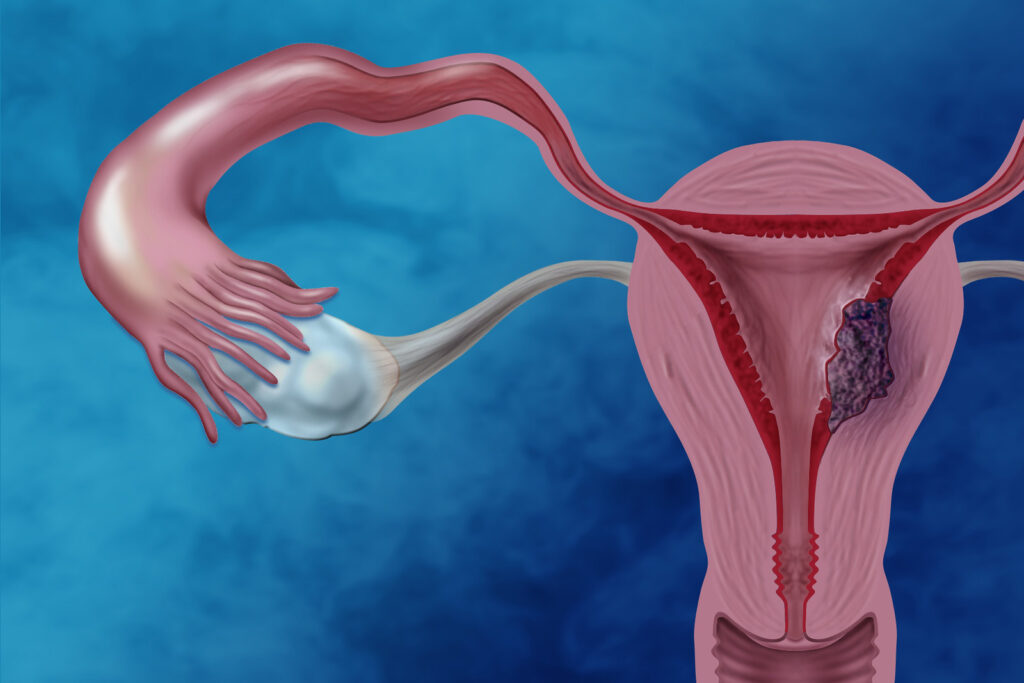 Types of cancer in women, symptoms of cervical cancer, early signs and symptoms of vulvar cancer, ovarian and fallopian tube cancer, Uterine cancer and endometrial cancer