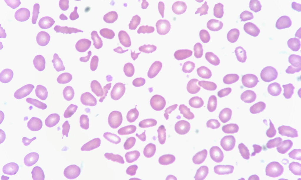 RBC abnormalities, Abnormal RBC shape, Abnormal red blood cell morphology, Anisocytosis, Poikilocytosis