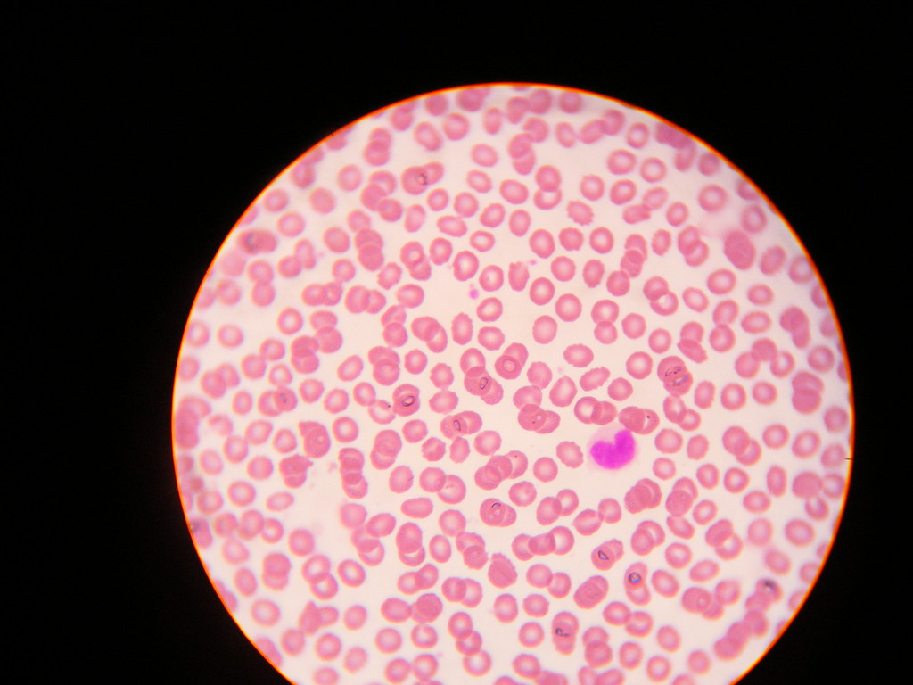 Normal WBC Count By Age, How To Increase WBC Count, How To Increase White Blood Cells Quickly, What Foods Increase White Blood Cells