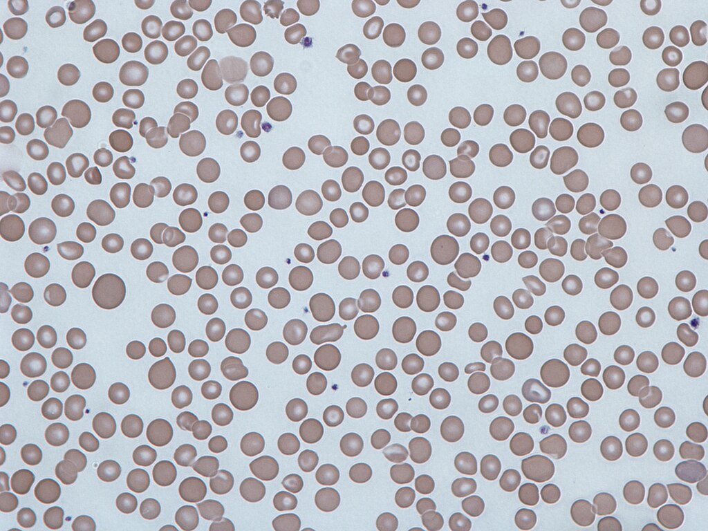 RBC abnormalities, Abnormal RBC shape, Abnormal red blood cell morphology, Anisocytosis, Poikilocytosis