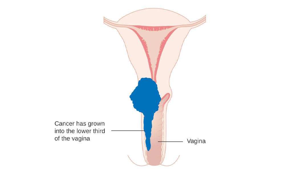 Types of cancer in women, symptoms of cervical cancer, early signs and symptoms of vulvar cancer, ovarian and fallopian tube cancer, Uterine cancer and endometrial cancer