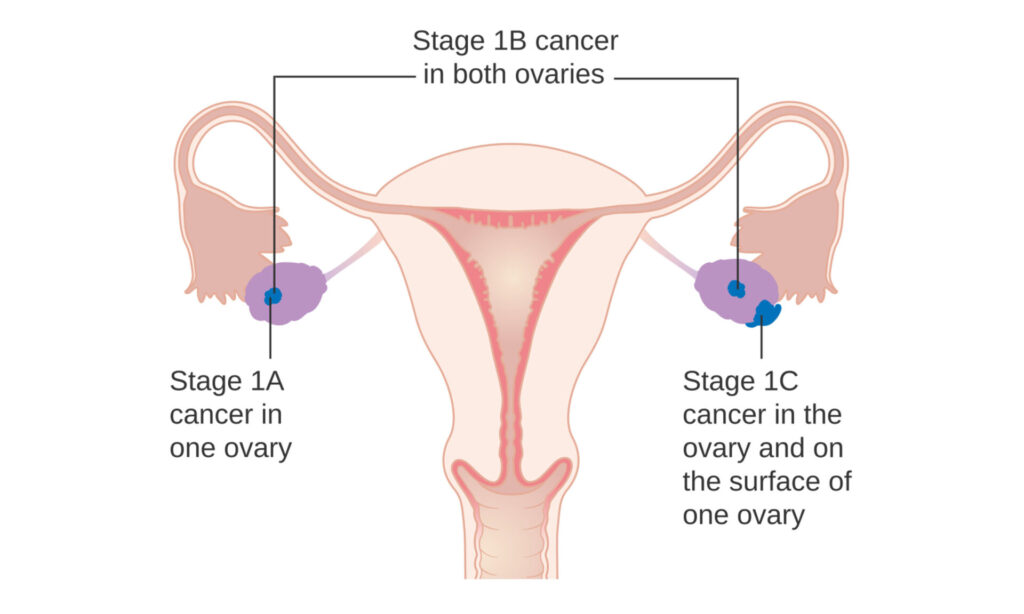 Types of cancer in women, symptoms of cervical cancer, early signs and symptoms of vulvar cancer, ovarian and fallopian tube cancer, Uterine cancer and endometrial cancer