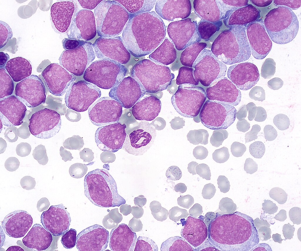 Leukemia blood smear, leukemia CBC results, leukemia blood count results, leukemia white blood cell count range, WBC count