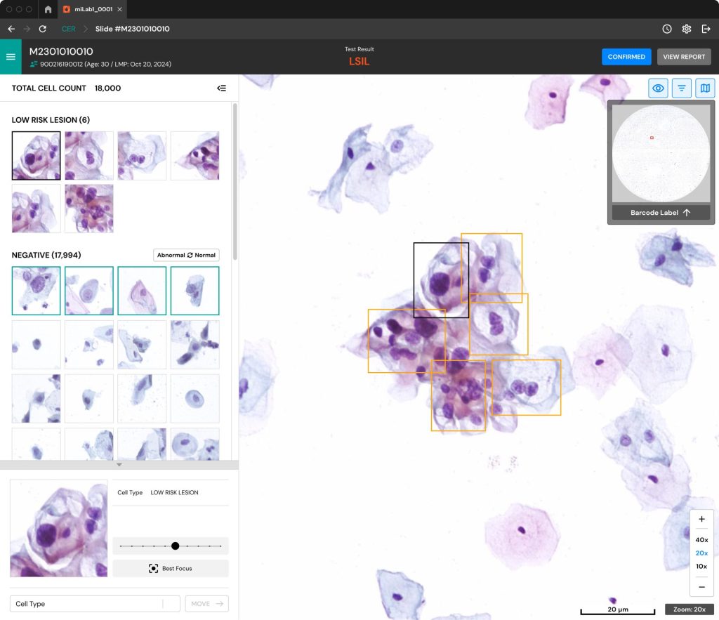 Friable cervix, glandular cells, reactive cellular changes, reactive endocervical cells, normal pap with inflammation